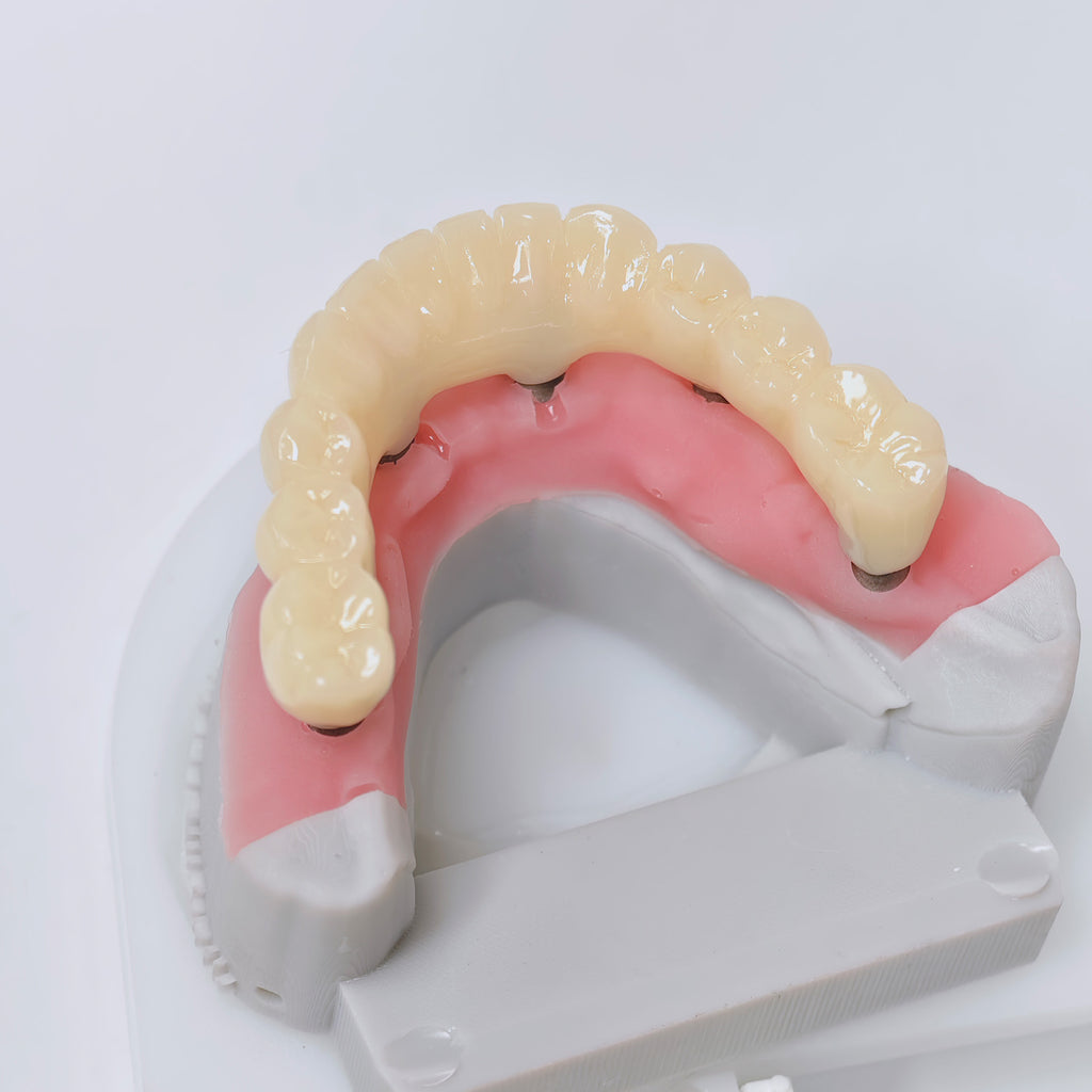 Custom Abutment And PMMA Bridge With Cement Retained And Implant Seating Guide