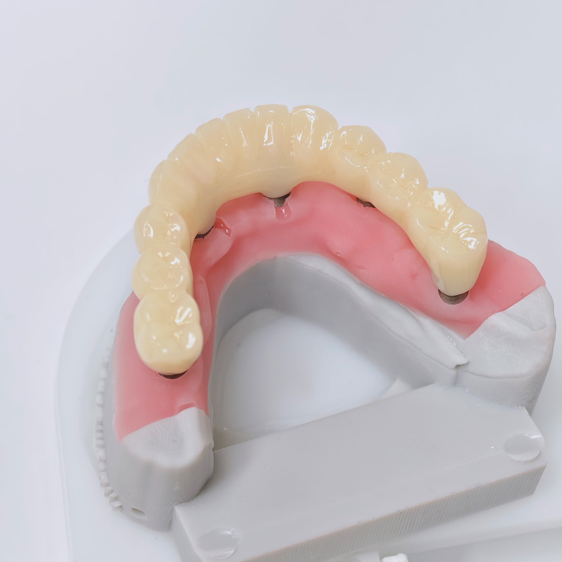 Custom Abutment And PMMA Bridge With Cement Retained And Implant Seating Guide