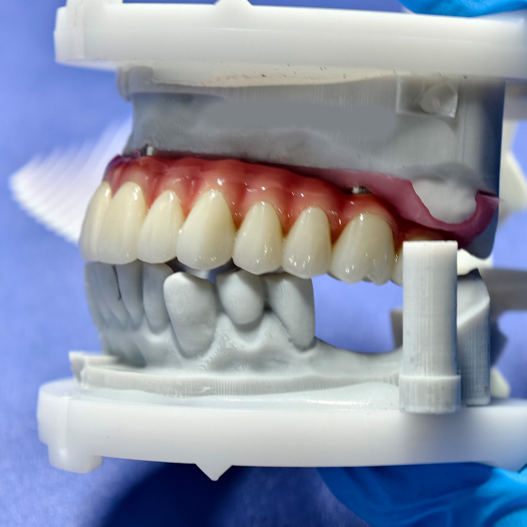 Enhanced Zirconia Crown Malo Bridge