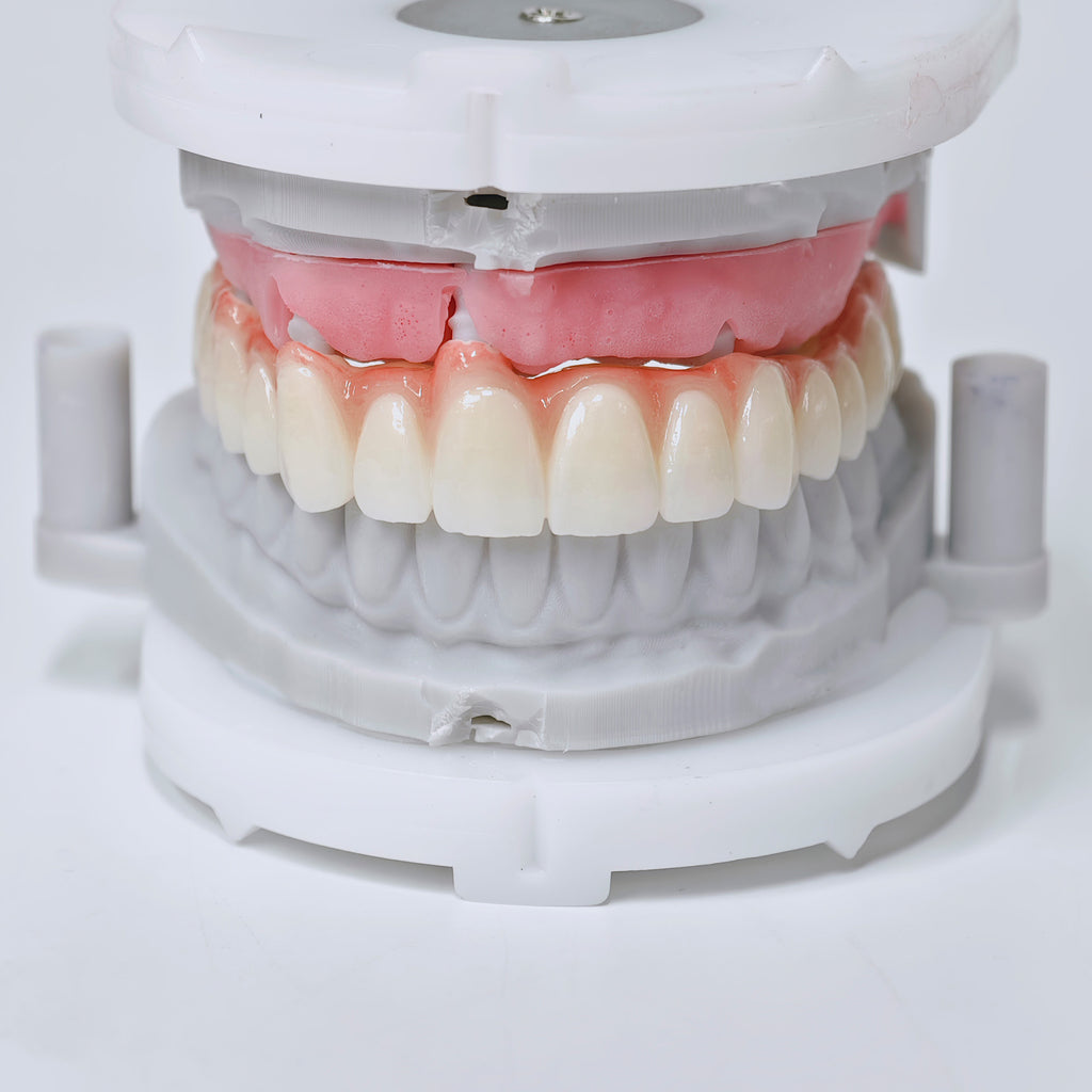 Half-Mouth Zirconia Bridge With Cement-Retained