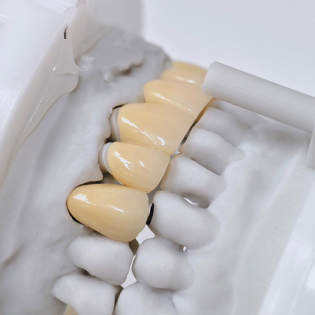 High - Strength Zirconia Crown And Bridge