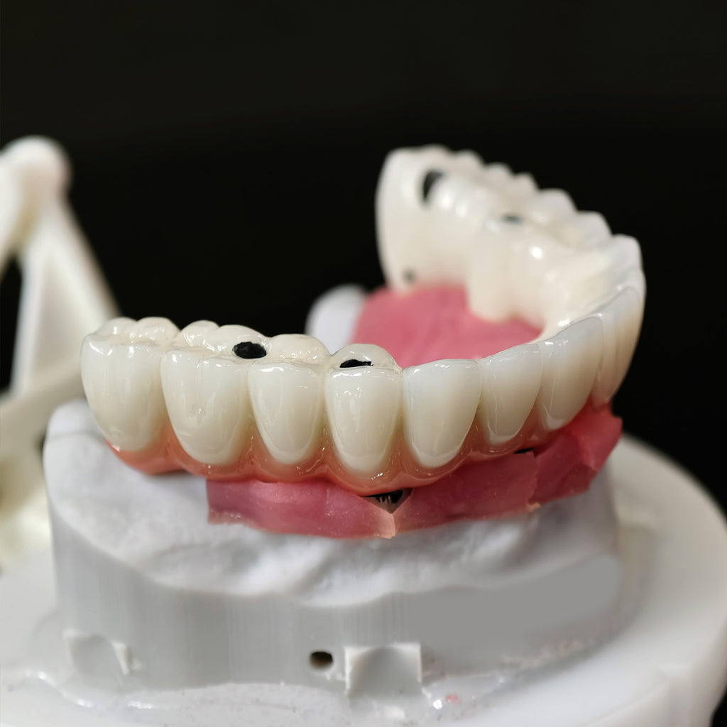 Implant-supported Co - Cr PFM Dental Bridge
