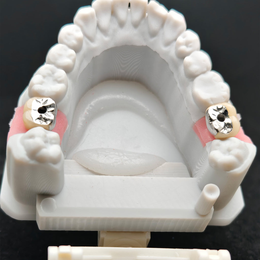 Implant-Supported PFM Single Crown With Metal