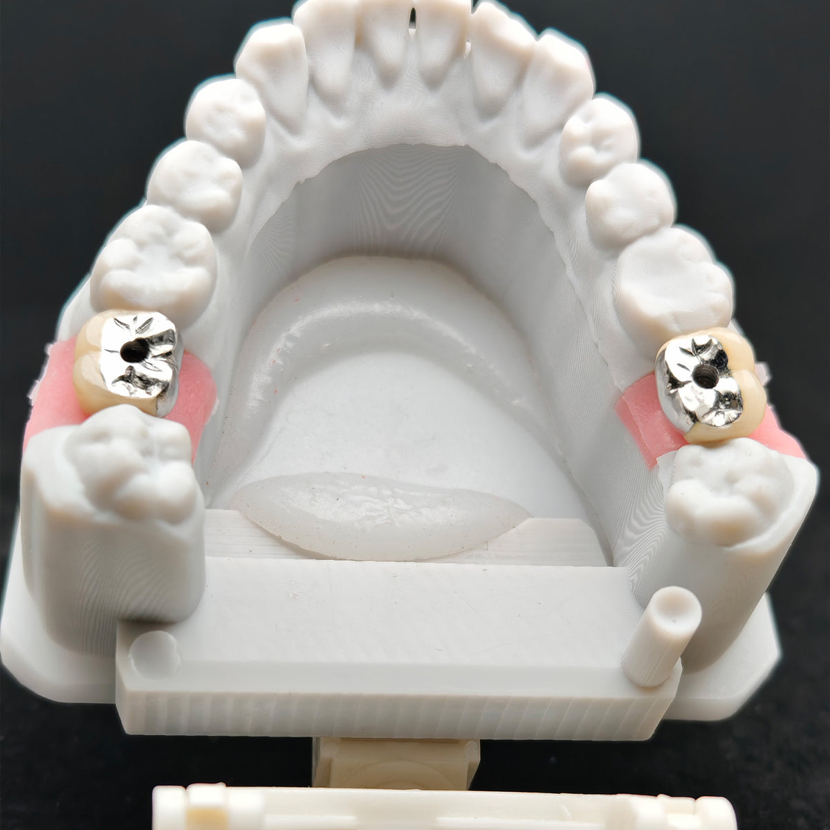Implant-Supported PFM Single Crown With Metal
