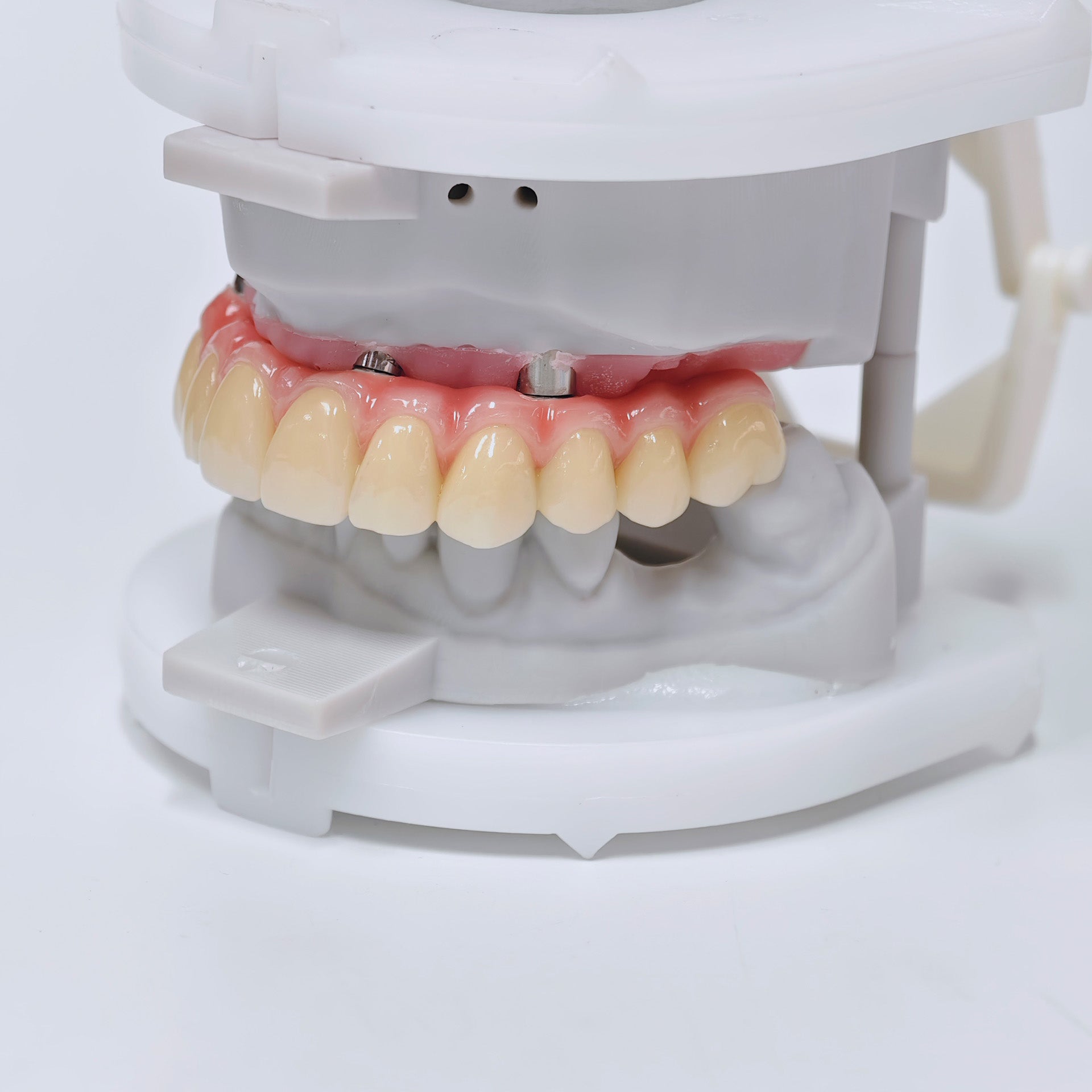 Malo Bridge With Screw-Retained