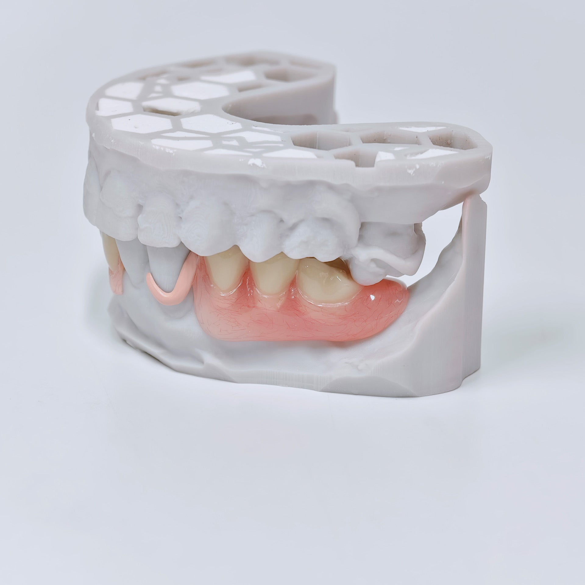 PEEK Framework Denture Metal Framework With Acrylic Denture