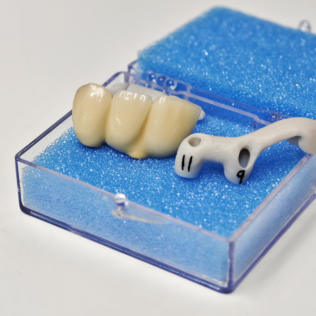 PFM Bridge With Screw-Retained And Implant Seating Guide