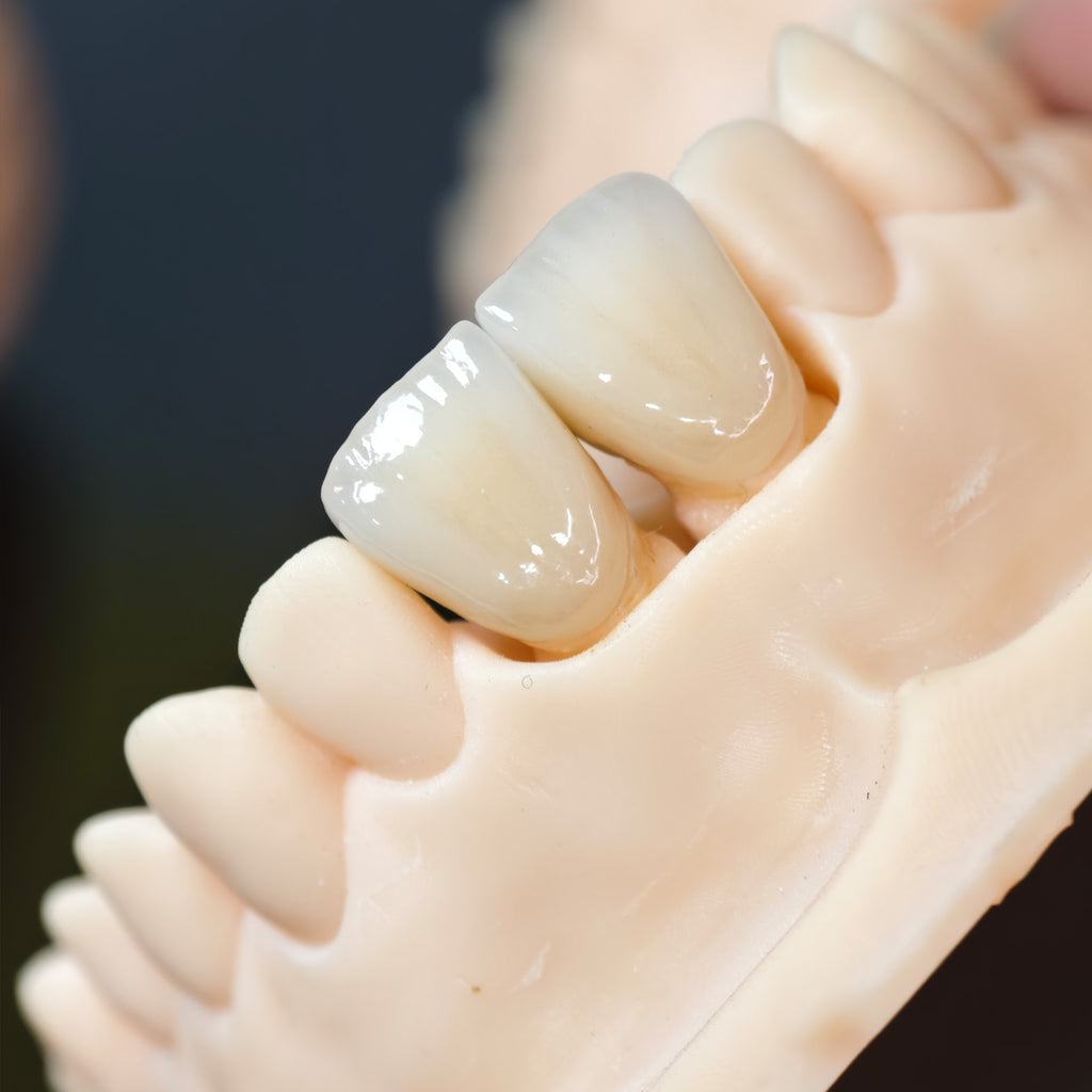 PFZ Crowns Aesthetic Shape Natural Shade Dental Crown