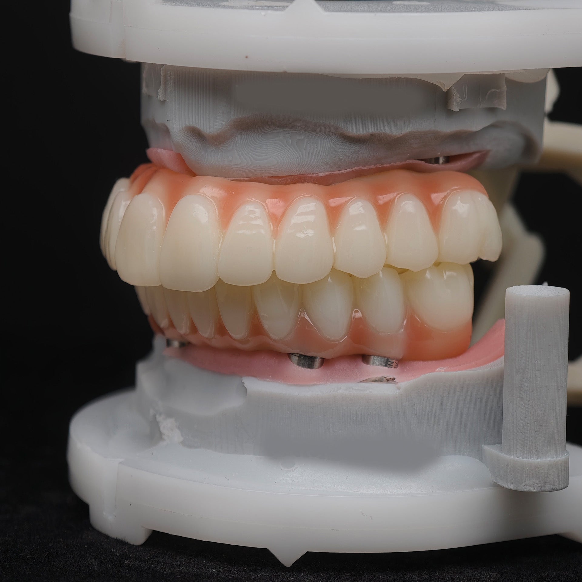 PMMA Bridge With Ti-Base Screw Retained Trying For Full Arch Restoration