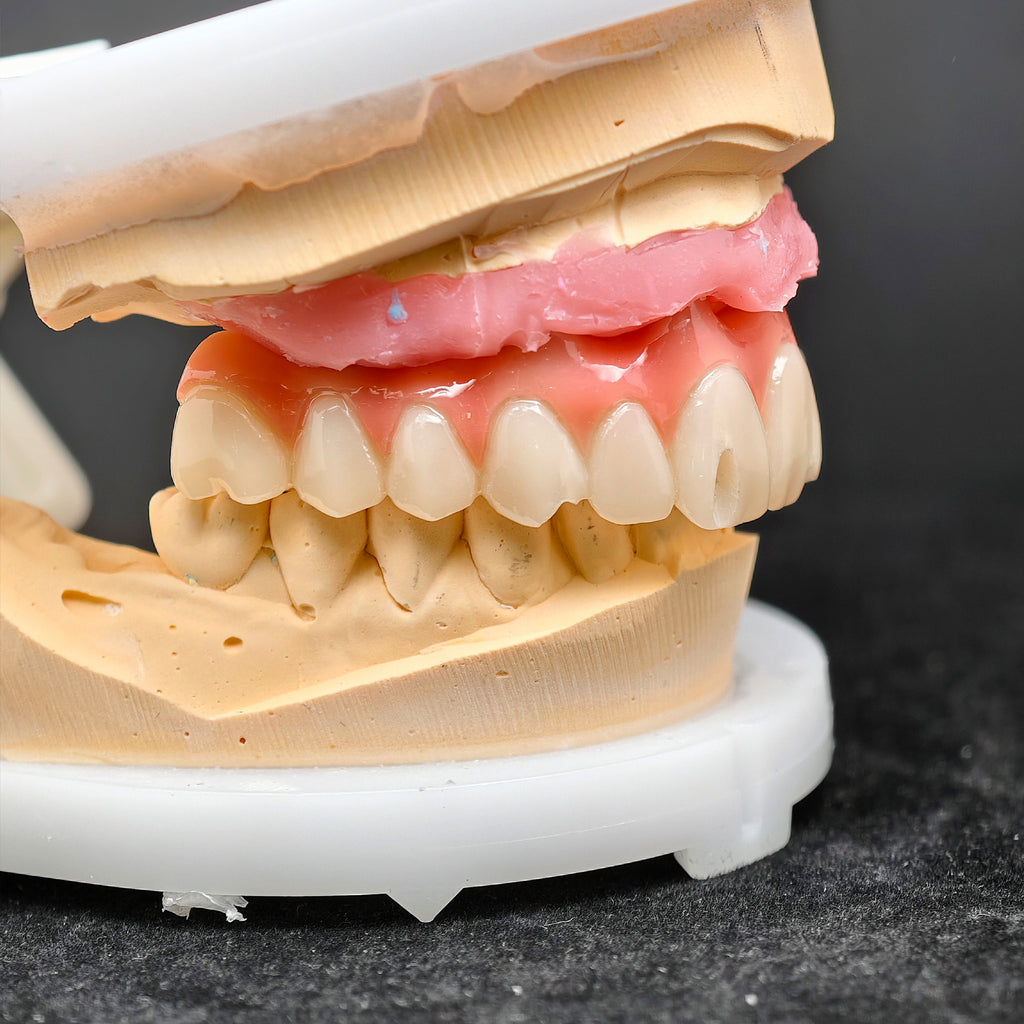 Pmma Bridge With Screw-Retained