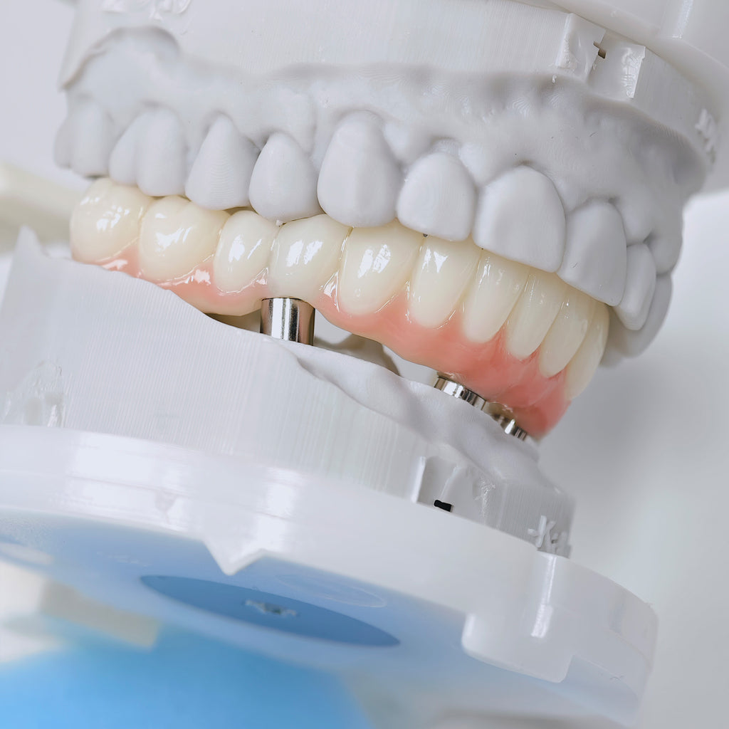 PMMA Bridge With Screw Retained