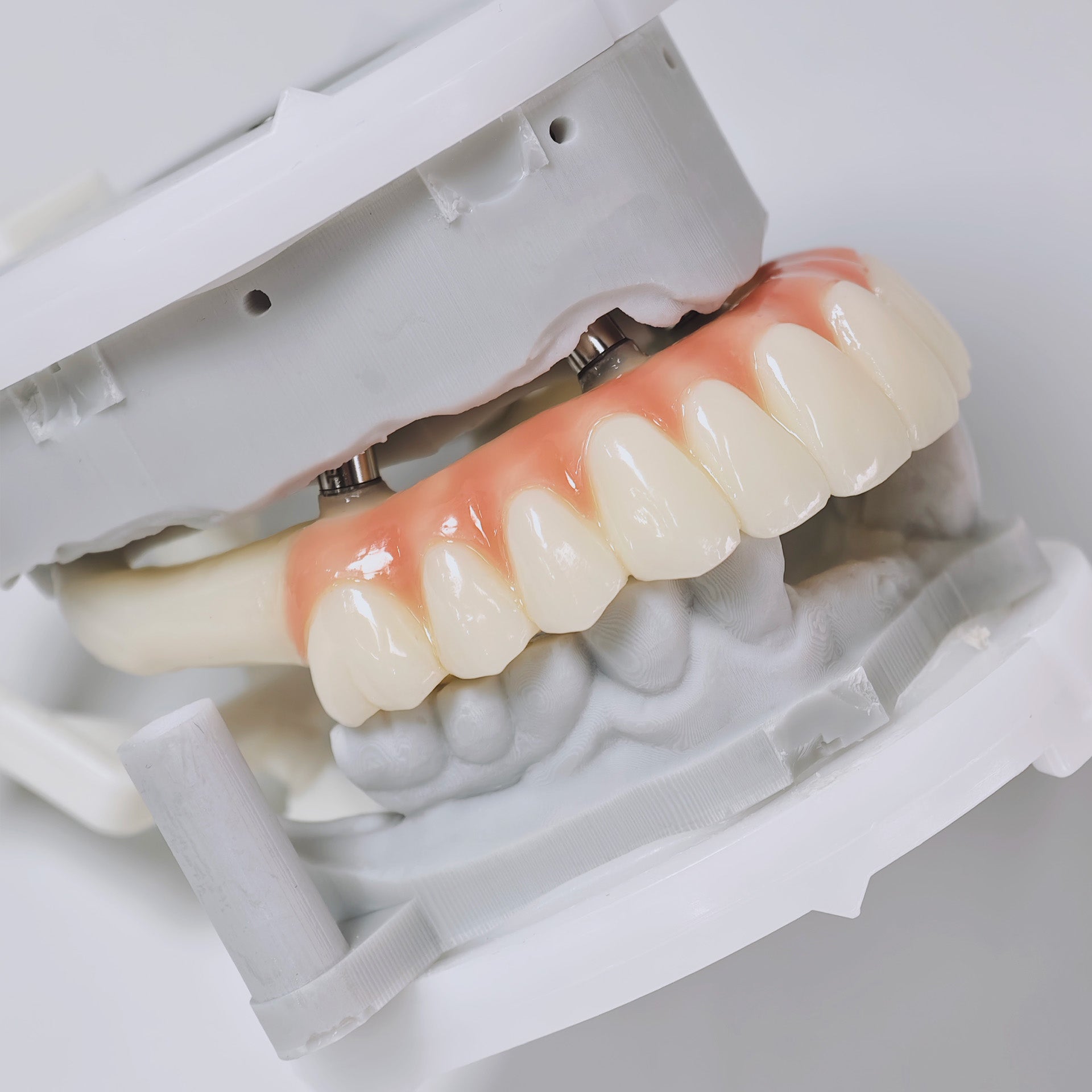 PMMA Bridge With Screw Retained