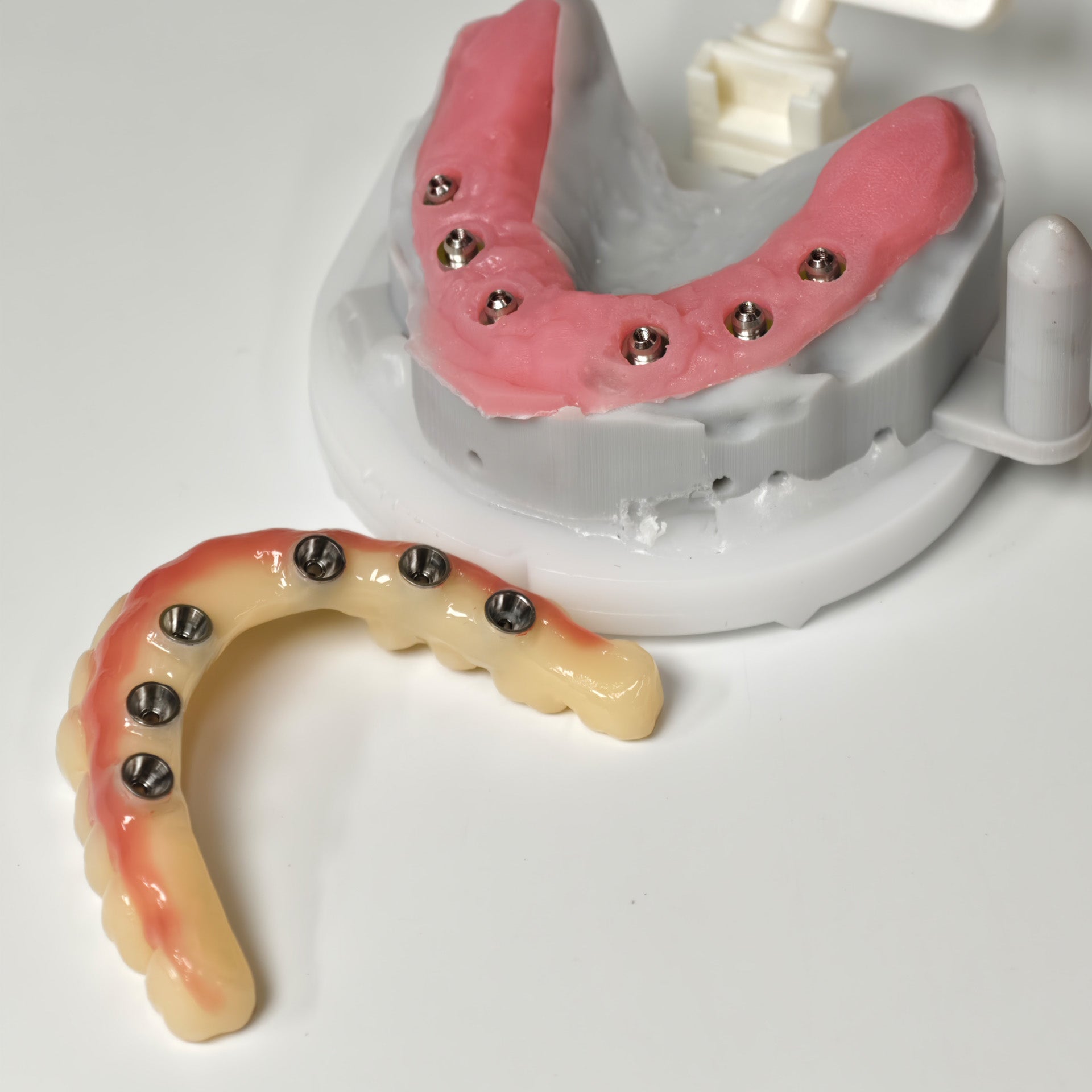 PMMA Bridge With Screw Retained