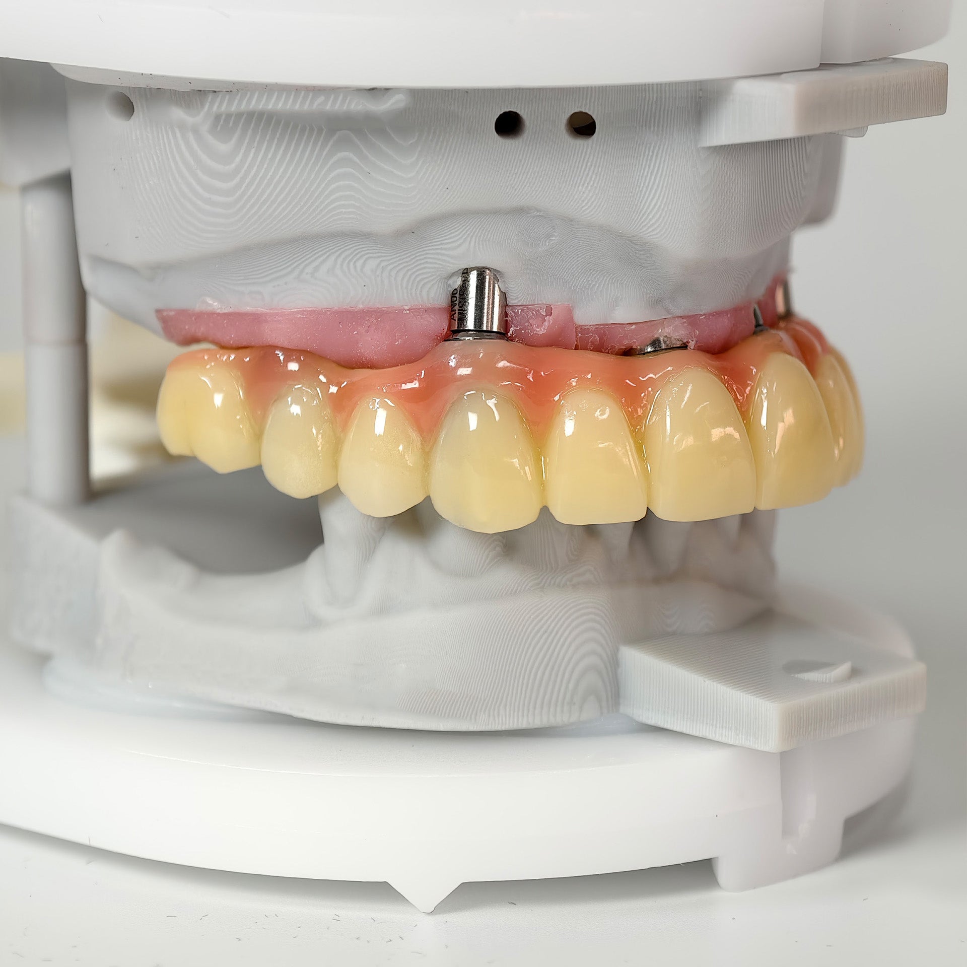 PMMA Bridge With Screw Retained
