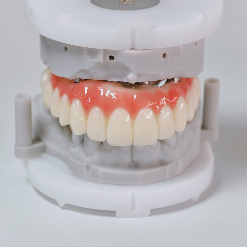 PMMA Bridge With Screw Retained