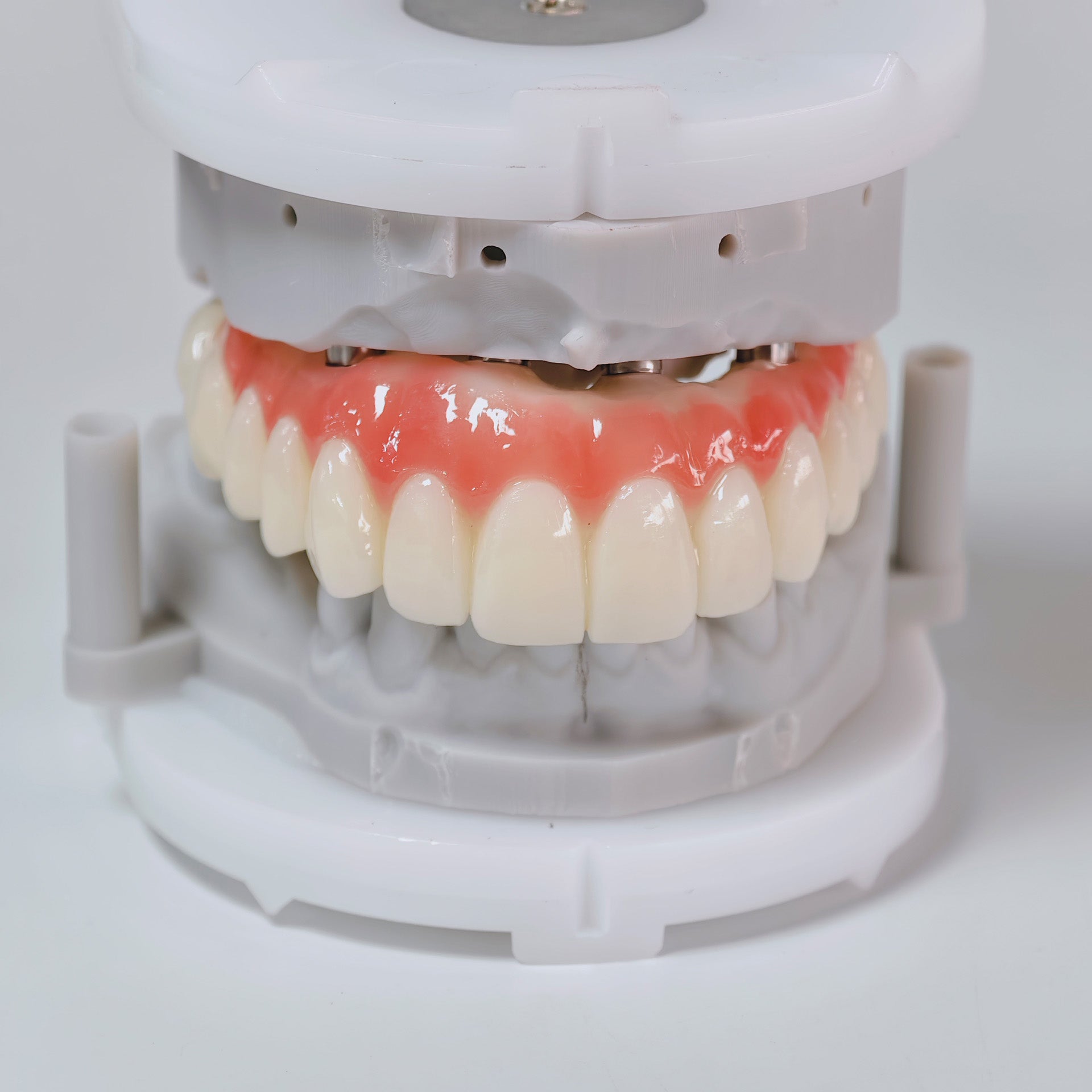 PMMA Bridge With Screw Retained