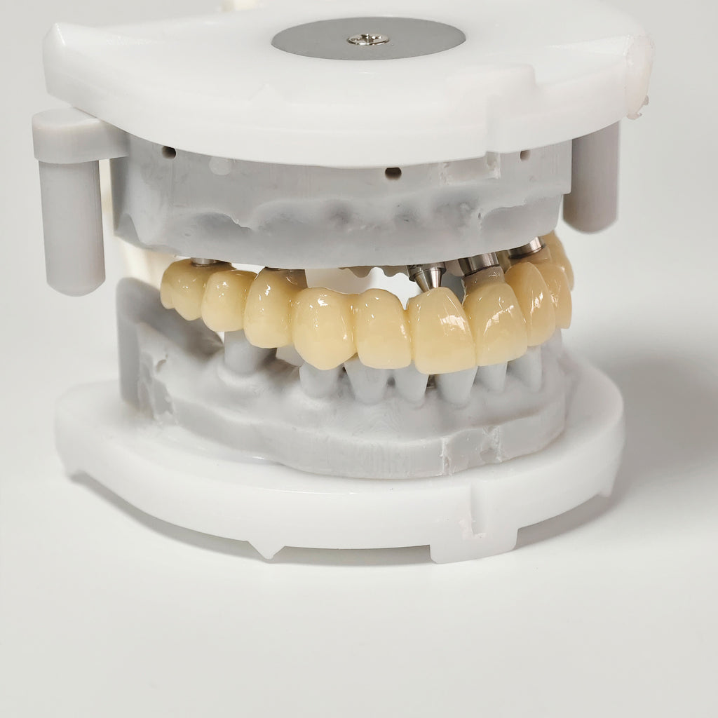 PMMA Bridge With Screw Retained