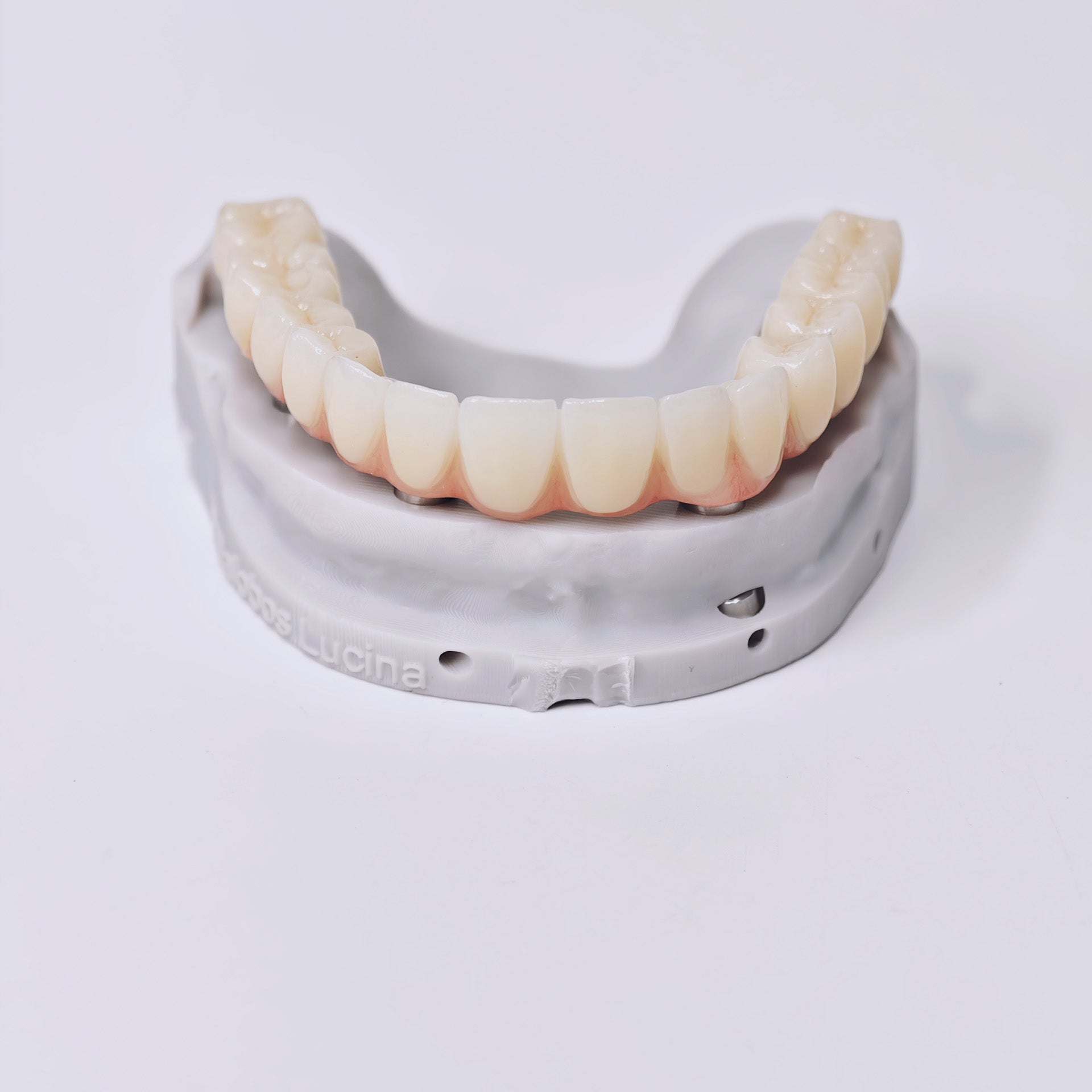 Ti-Bar Titanium Gold-Plated Metal Frame With Zirconia Bridge And Screw Retained