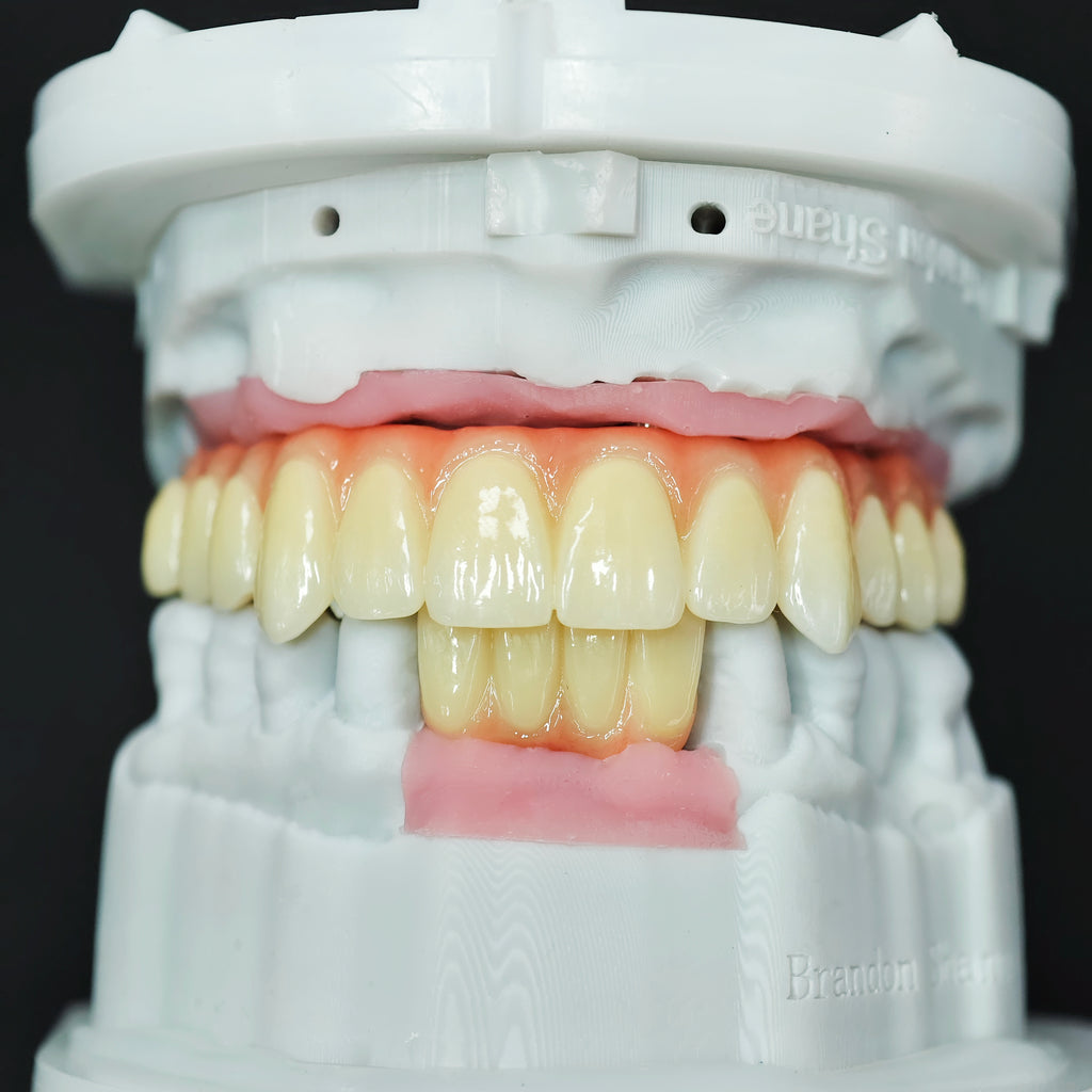 Ti-Bar Titanium Nitride Metal Frame With Zirconia Bridge For Full Arch Restoration