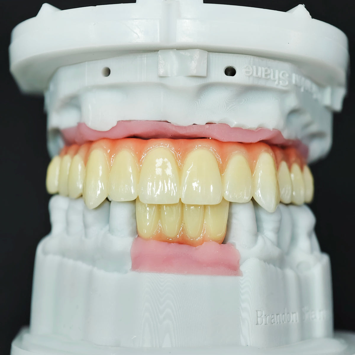 Ti-Bar Titanium Nitride Metal Frame With Zirconia Bridge For Full Arch Restoration