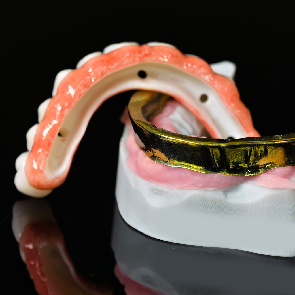 Ti-Bar Titanium Nitride Metal Frame With Zirconia Bridge For Full Arch Restoration