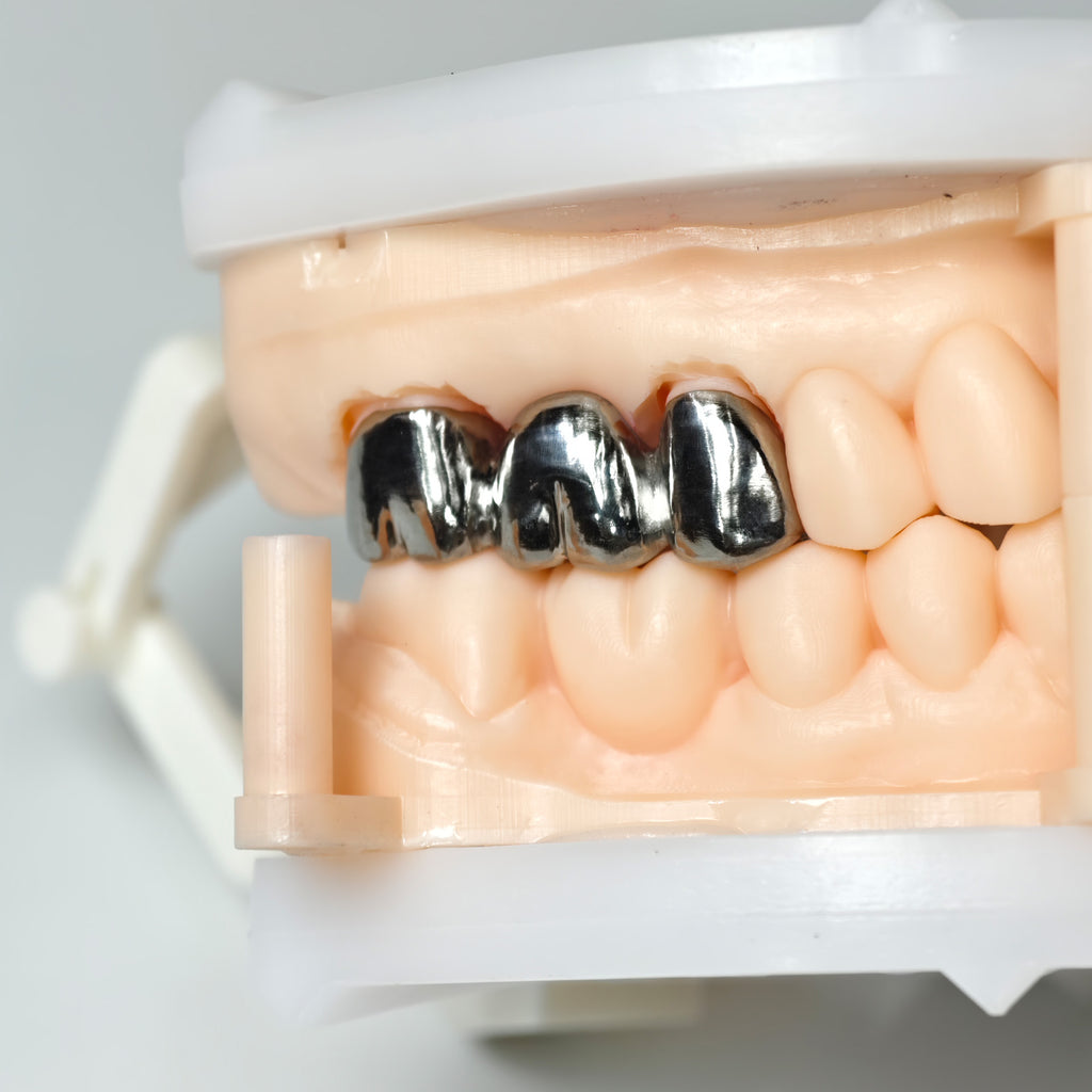 Titanium Crown With Cement Retained