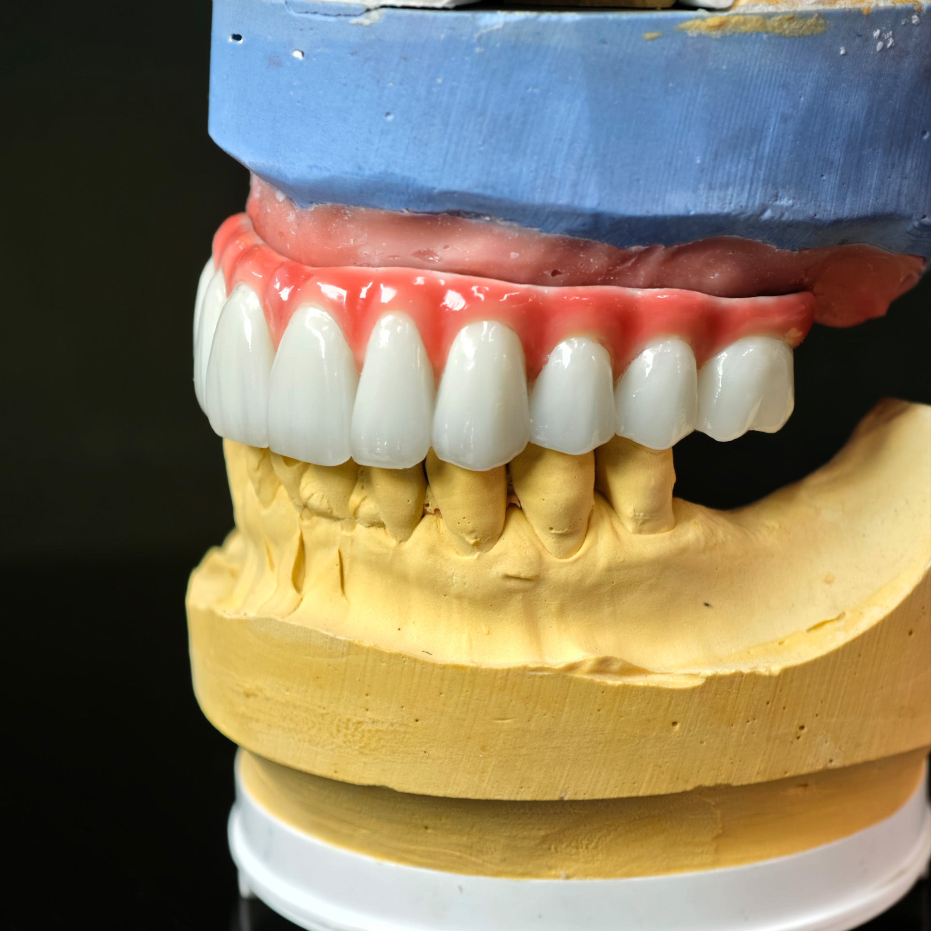 Traditional Malo Bridge With Alloy Framework Covering The Gingiva