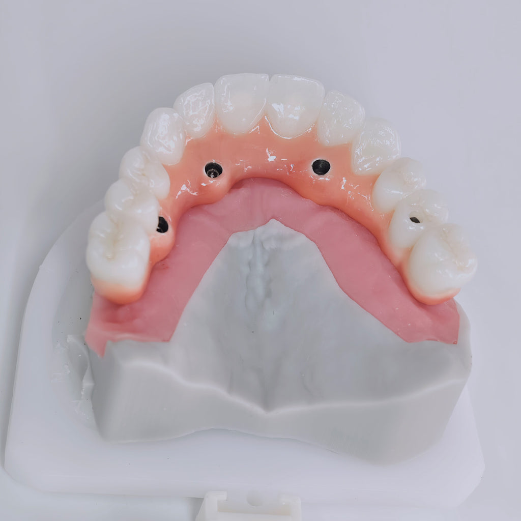 Zirconia-Enamel Hybrid Malo Bridge Aesthetic