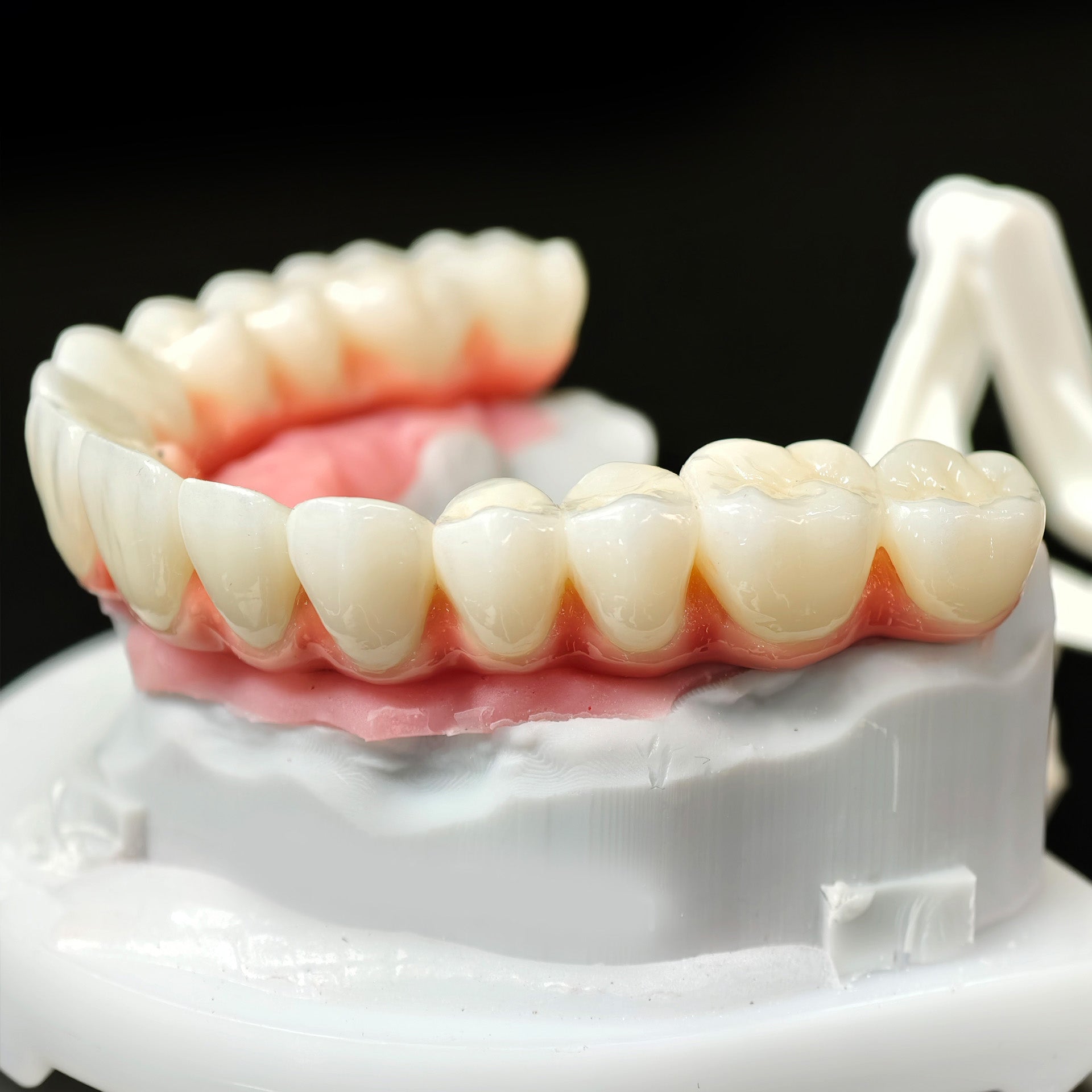Zirconia-Enamel Hybrid Malo Bridge