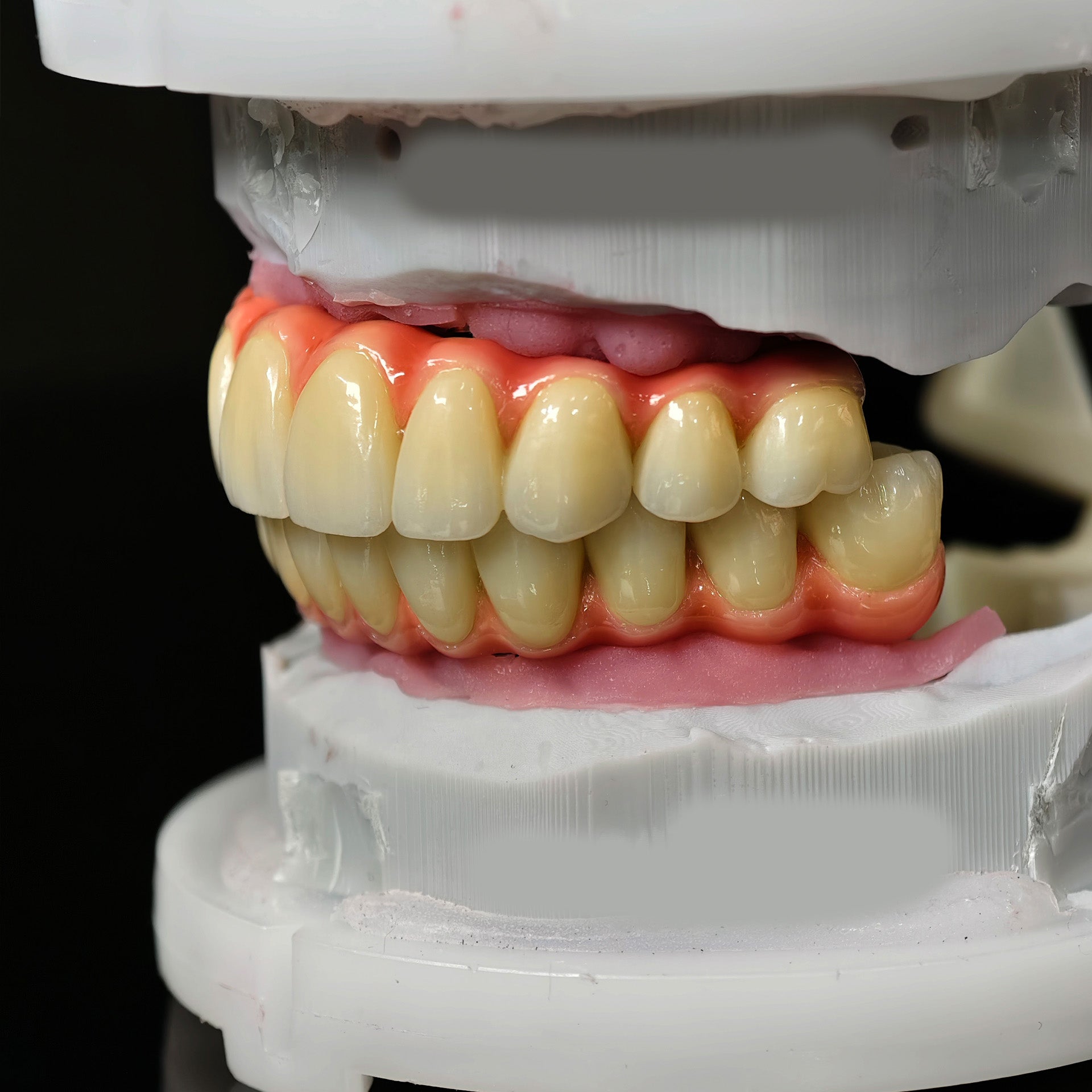 Zirconia-Enamel Hybrid Malo Bridge