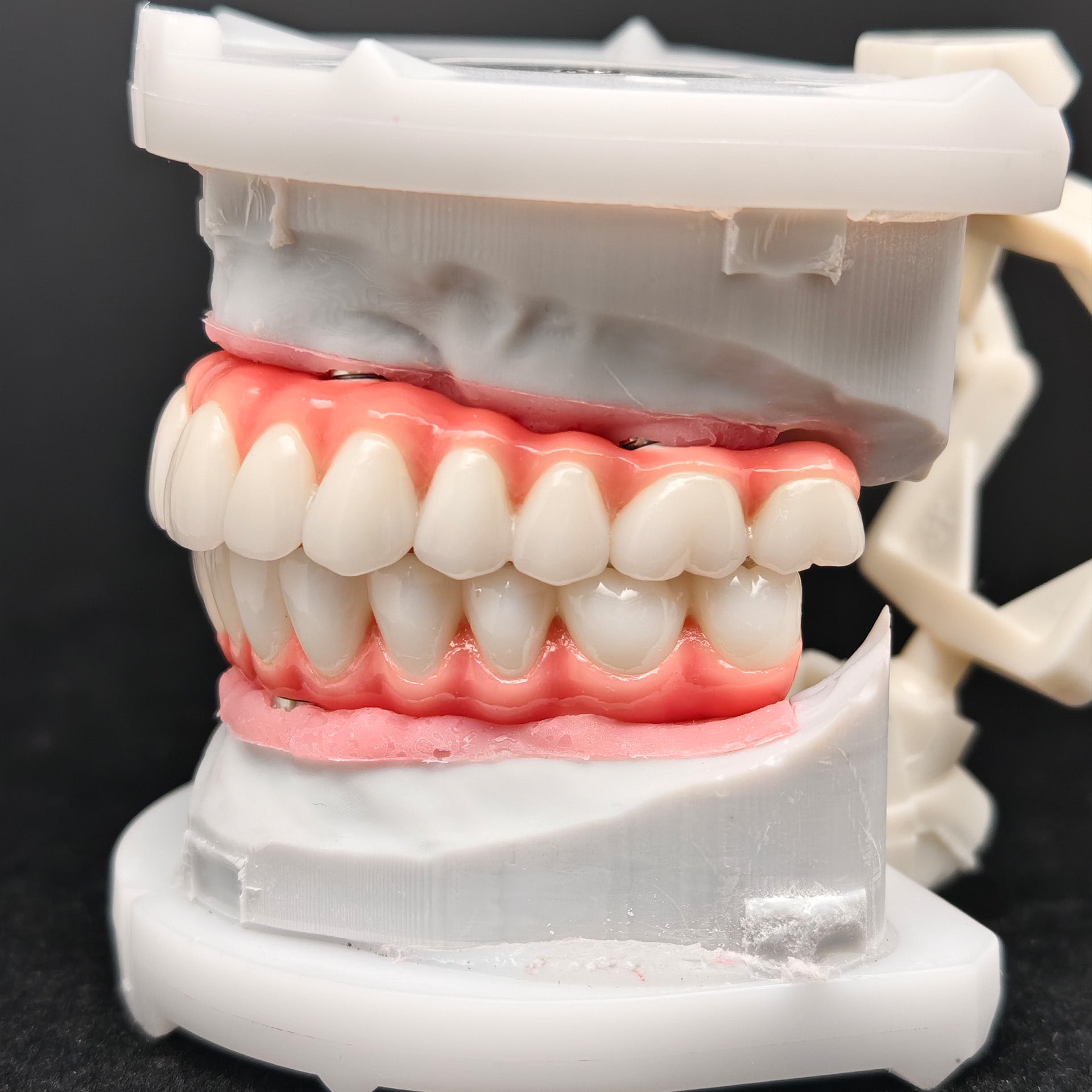Zirconia-Enamel Hybrid Malo Bridge