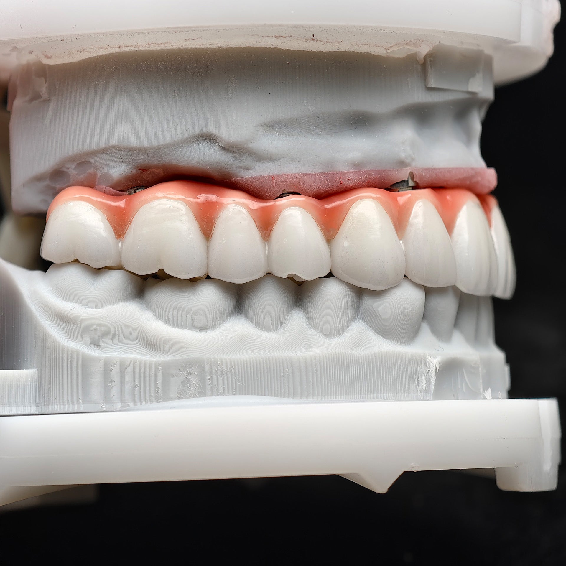 Zirconia-Enamel Hybrid Malo Bridge