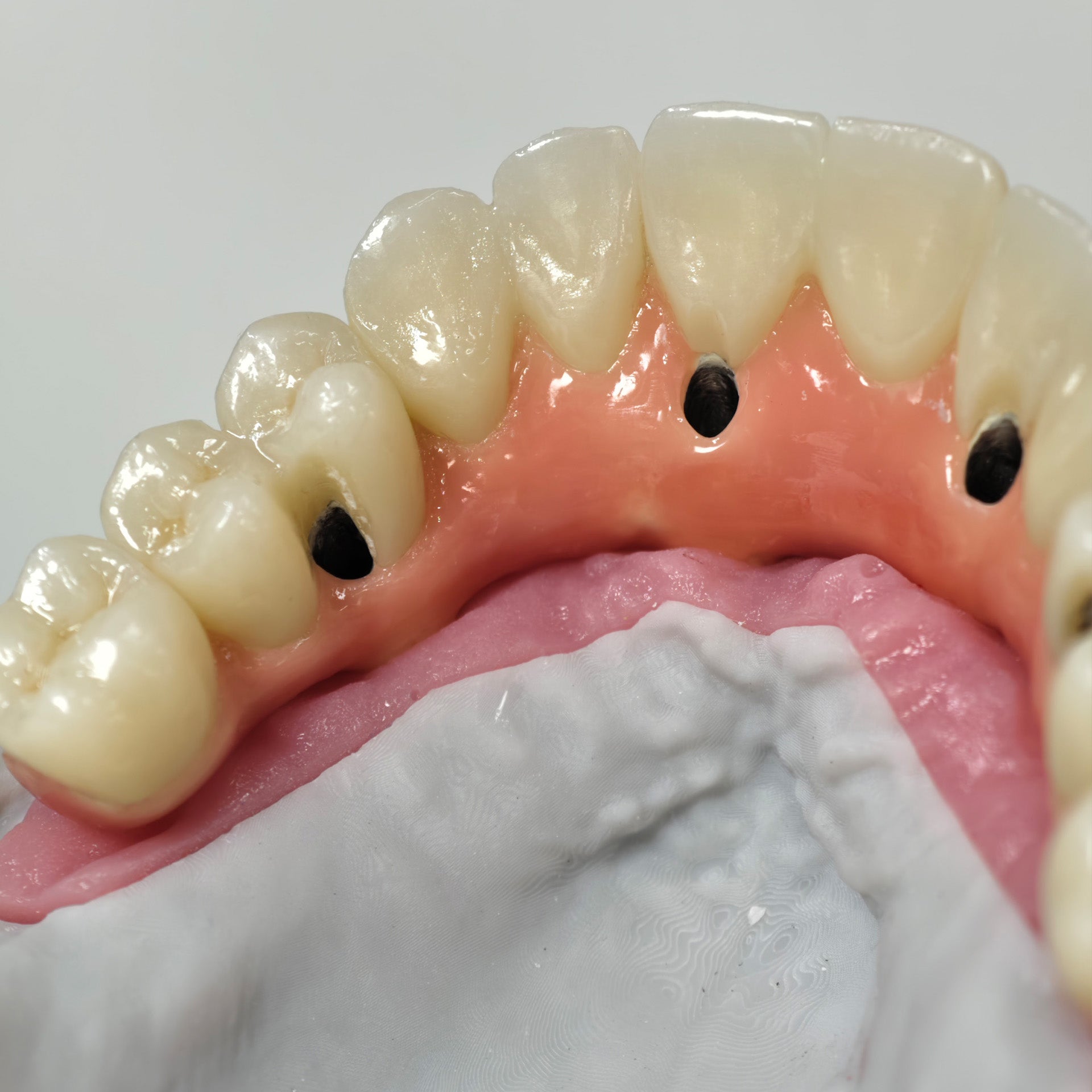 Zirconia-Enamel Hybrid Malo Bridge