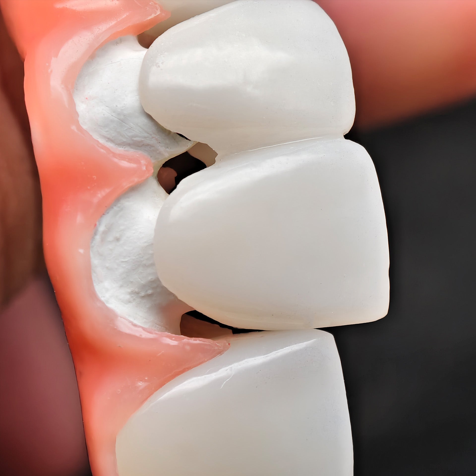 Zirconia-Enamel Hybrid Malo Bridge