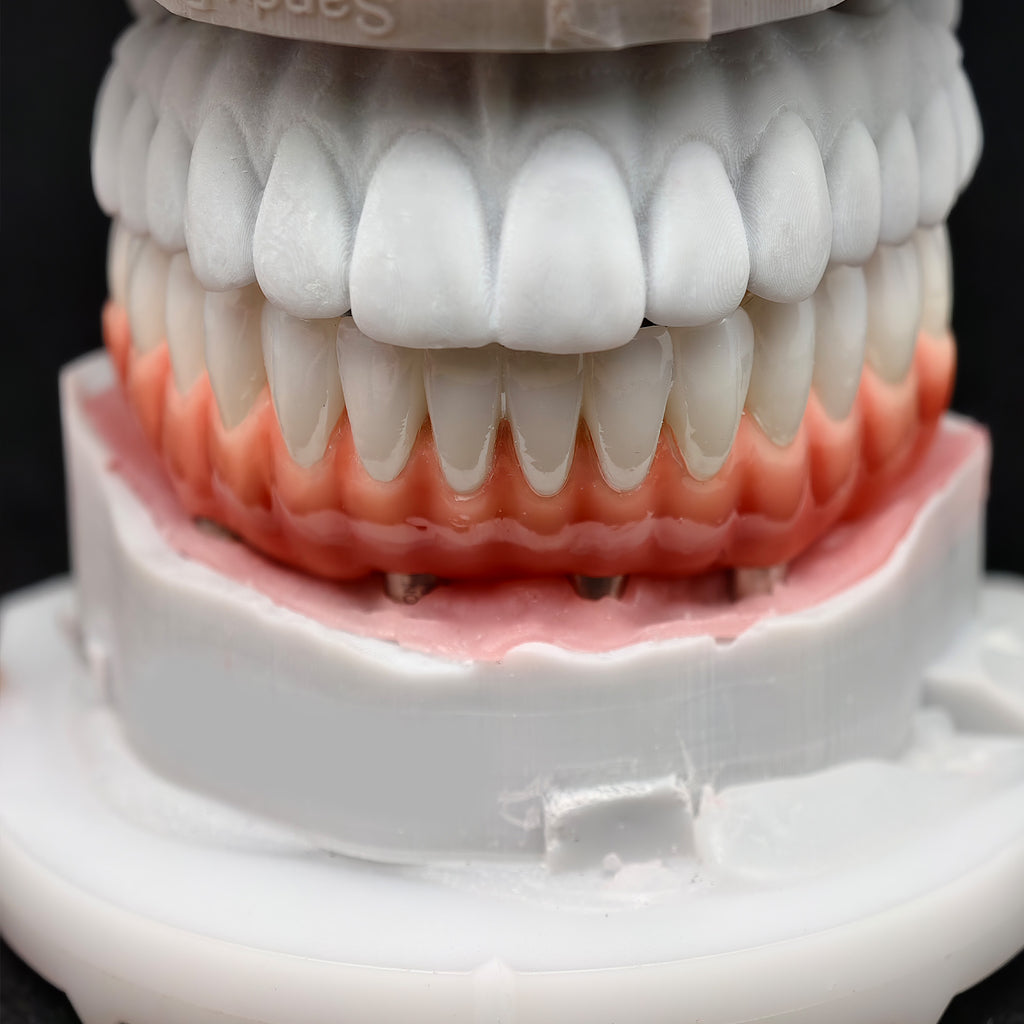 Zirconia-Enamel Hybrid Malo Bridge