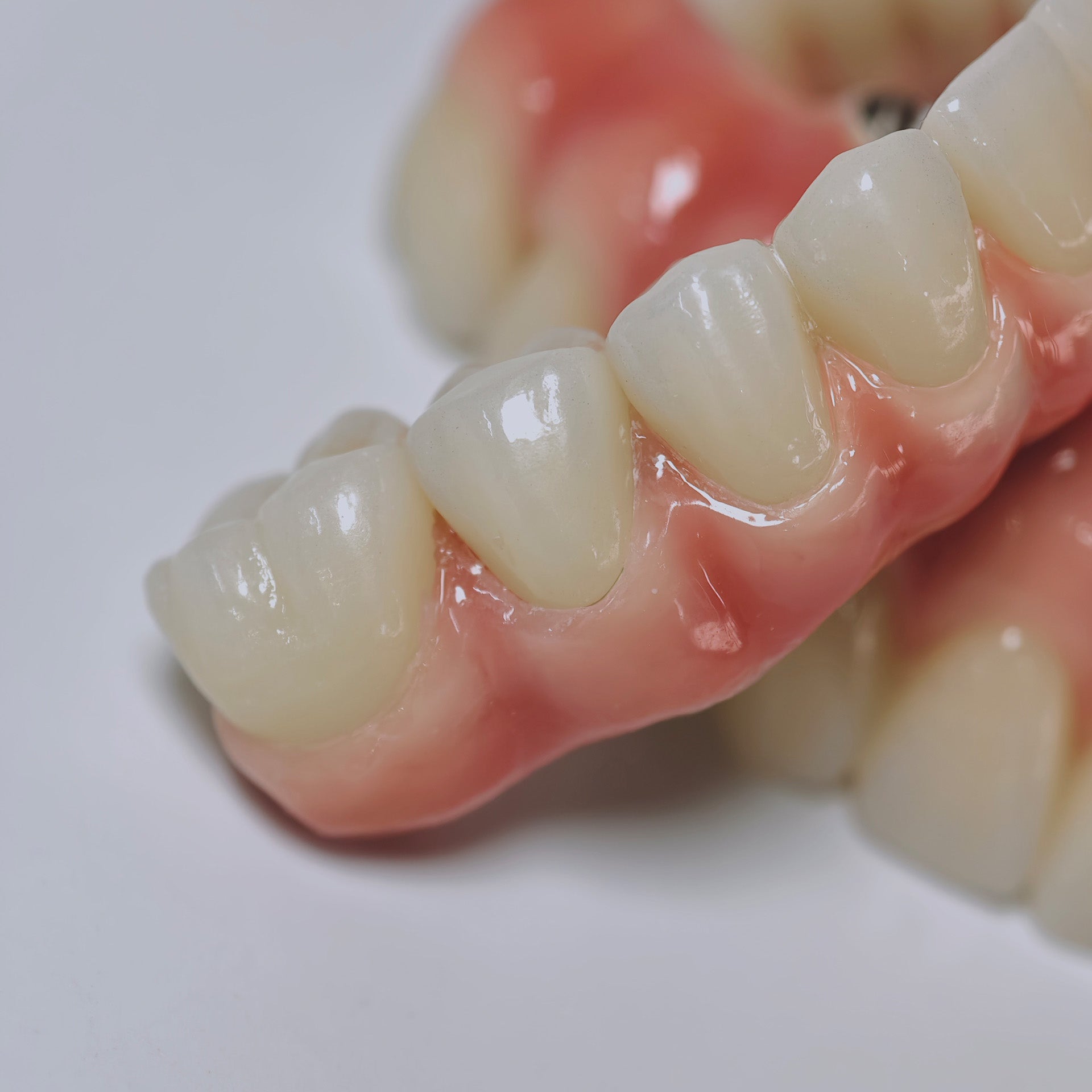 Zirconia-Enamel Hybrid Malo Bridge