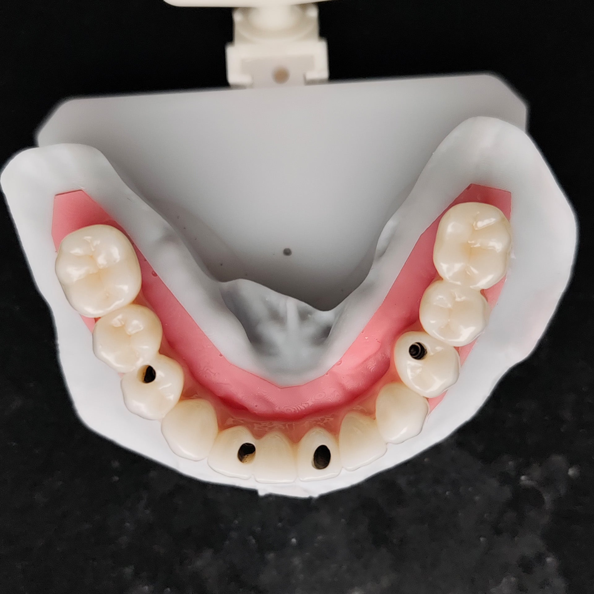 Zirconia-Enamel Hybrid Malo Bridge