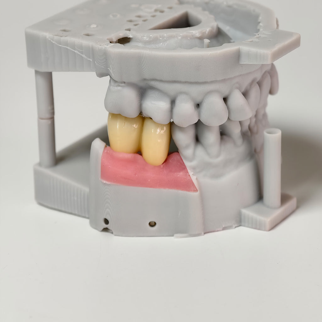 Zirconia Bridge With Screw Retained