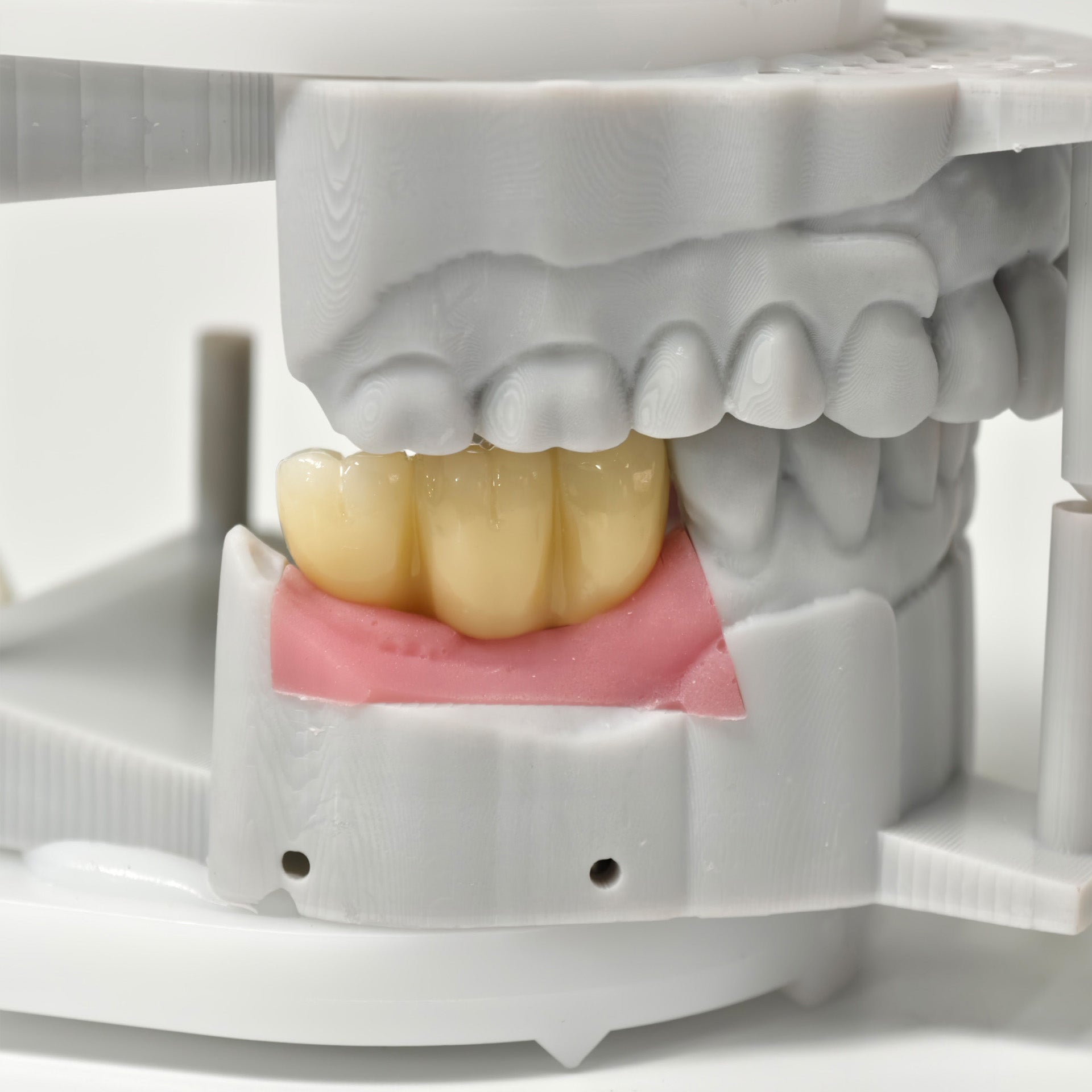Zirconia Bridges With Screw Retained