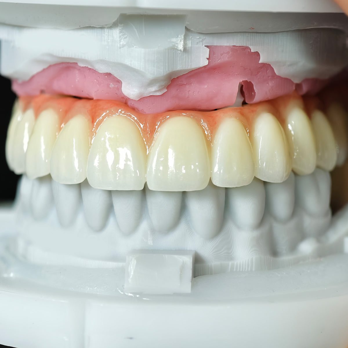 Zirconia Bridge With Cement Retained