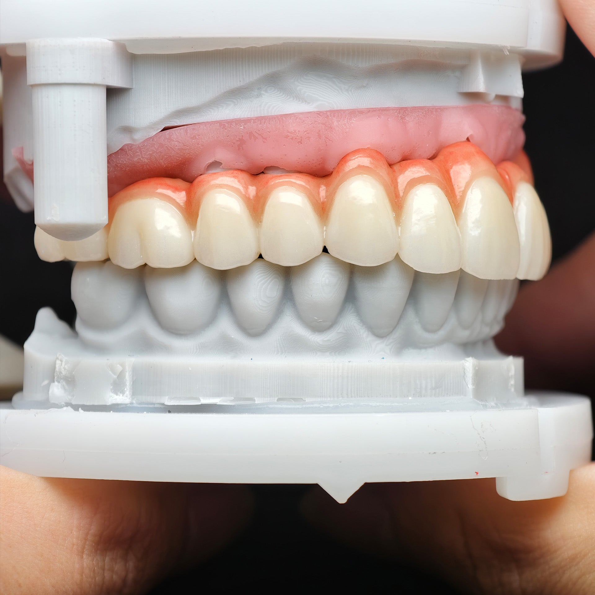 Zirconia Bridge With Cement Retained