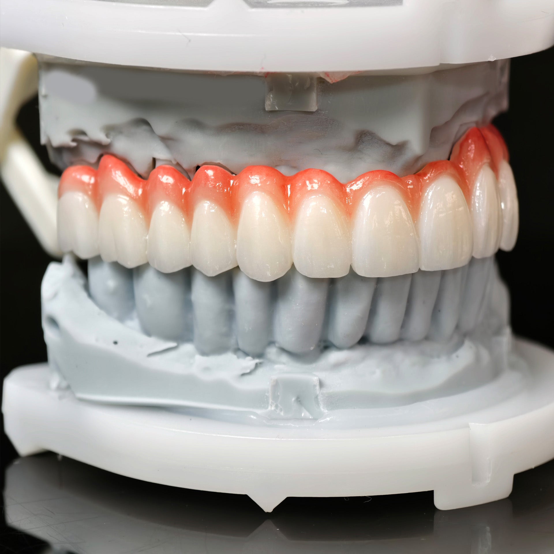 Zirconia Bridge With Cement Retained And Titanium Bar