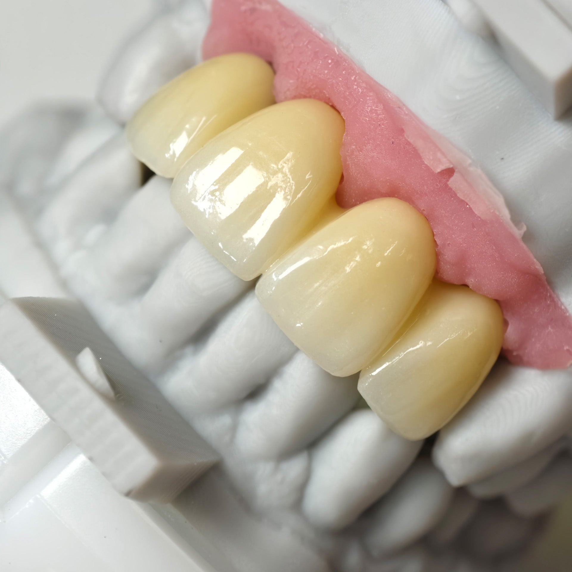 Zirconia Bridge With Screw Retained
