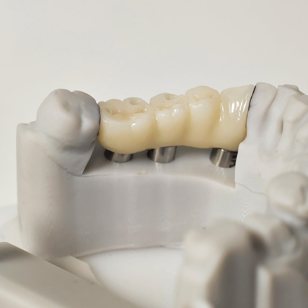 Zirconia Bridge With Ti-Base Screw Retained