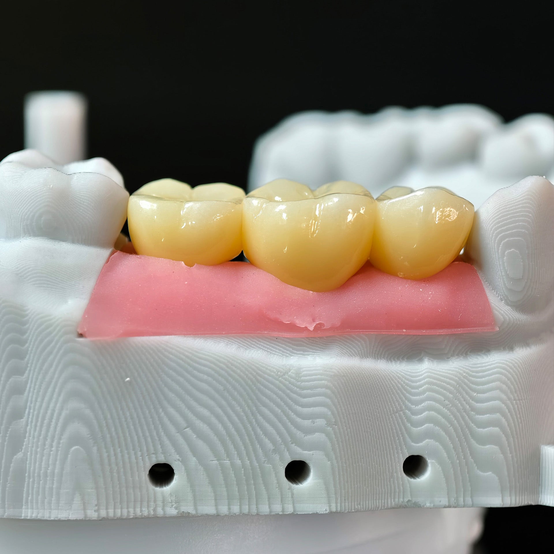 Zirconia Crowns With Gold-Plated Abutment And Implant Seating Guide