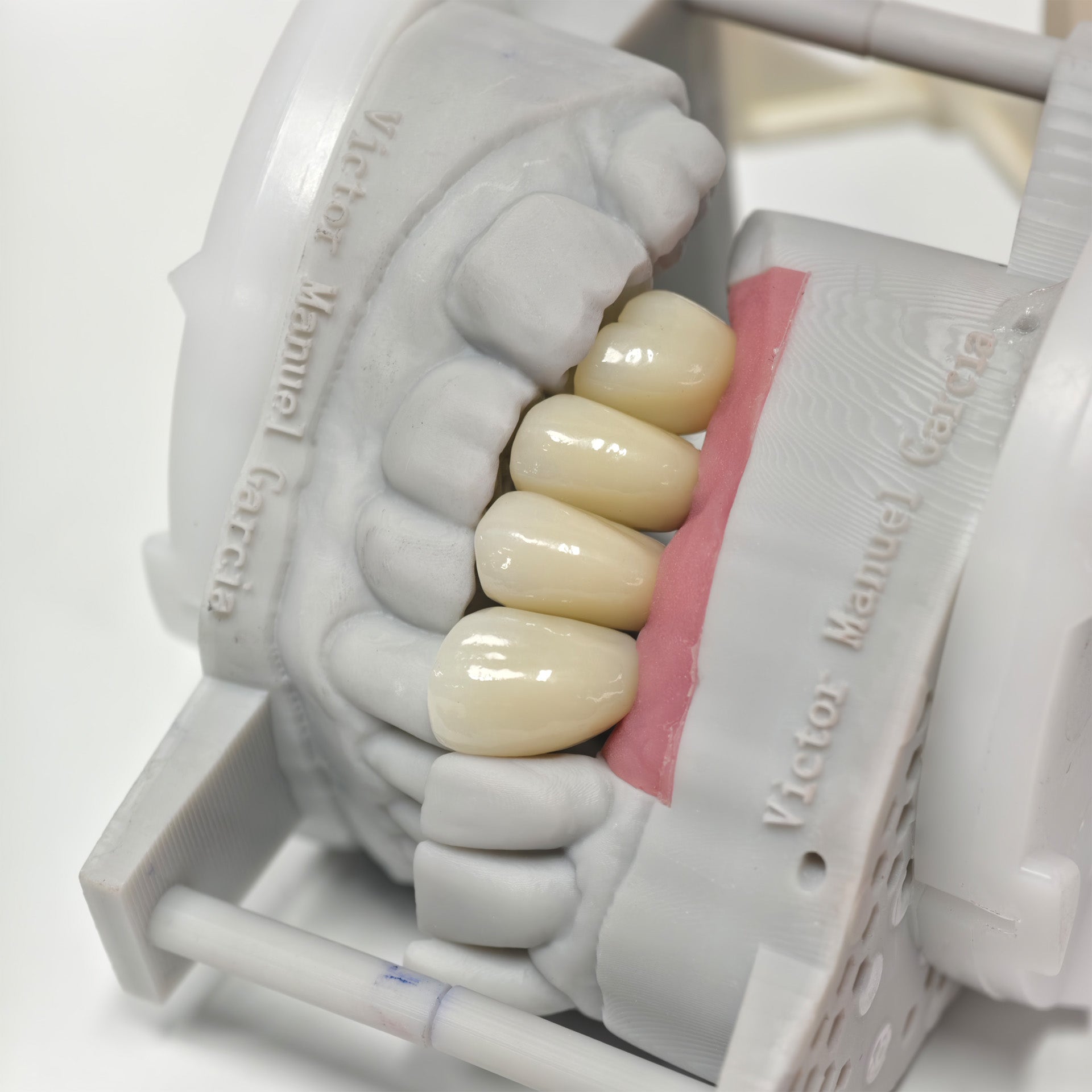 Zirconia Crowns With Screw Retained