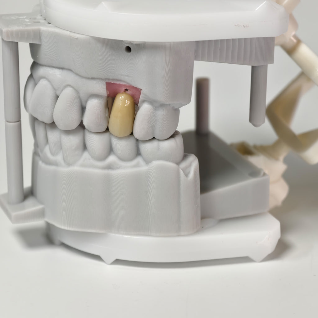 Zirconia Crowns With Screw Retained