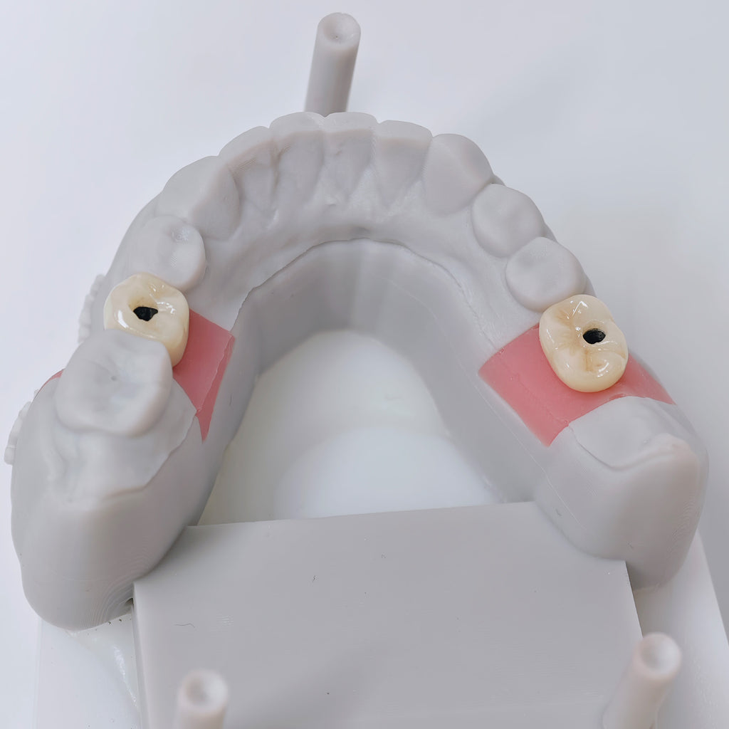 Zirconia Crowns With Screw Retained