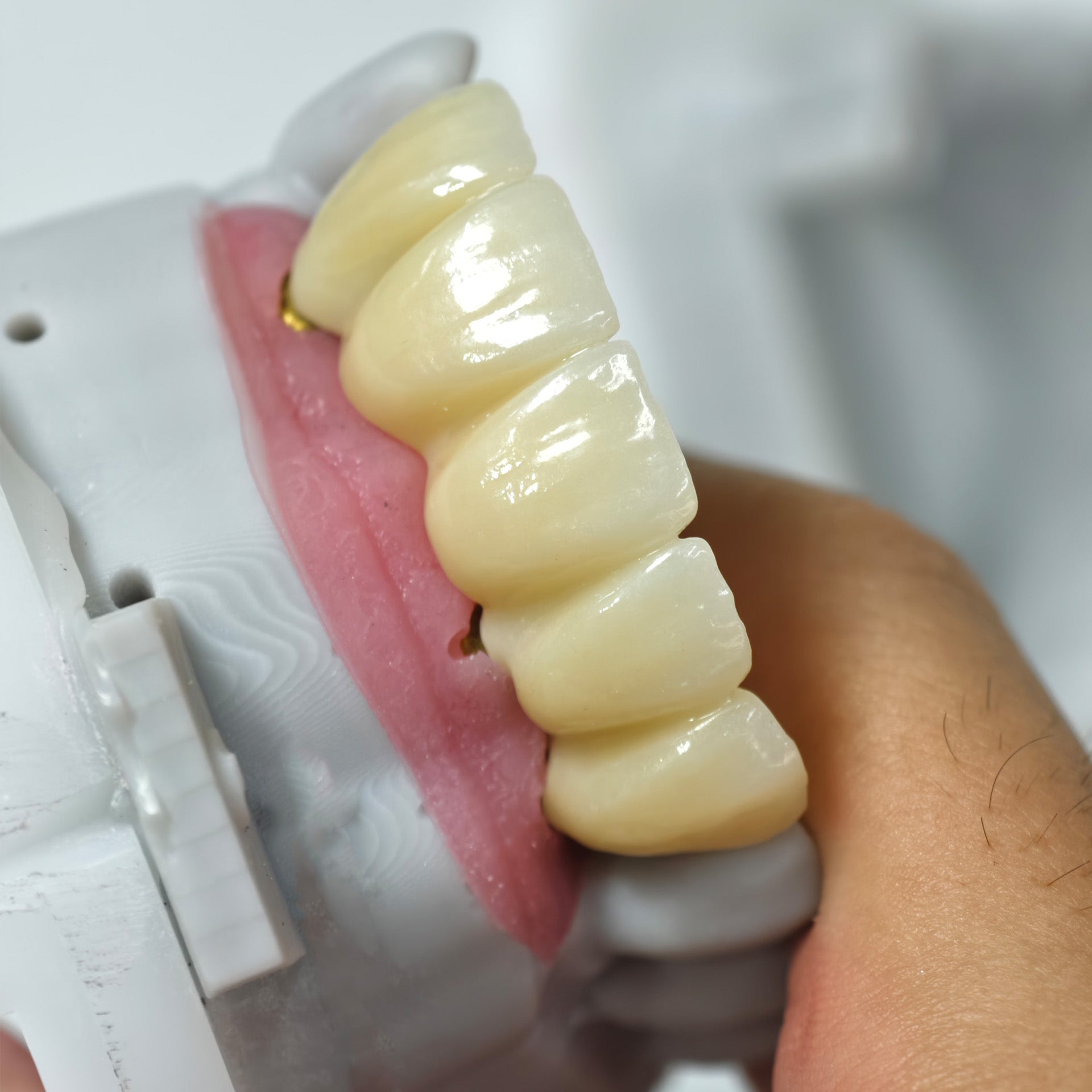 Zirconia Implant Bridge Screwmentable Dental Crown