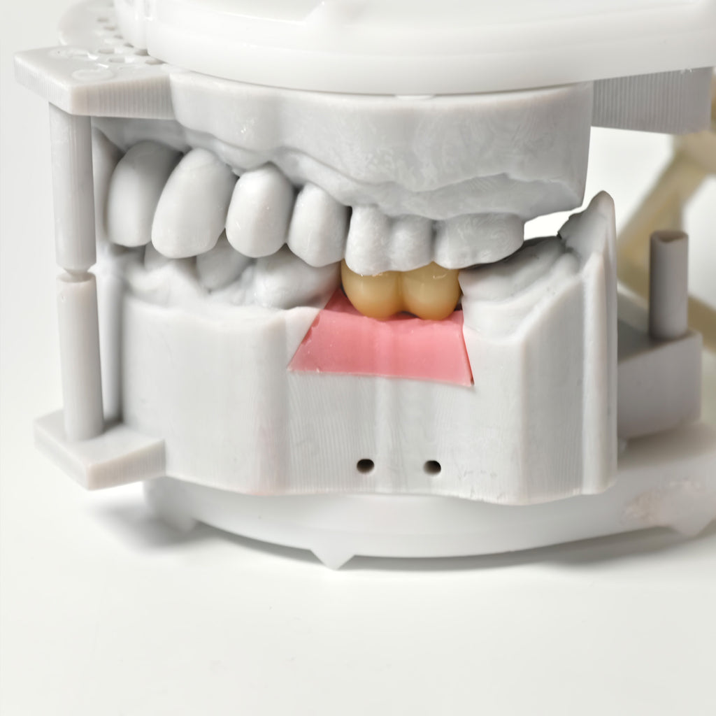 Zirconia Implant Bridge Screwmentable Dental Crown